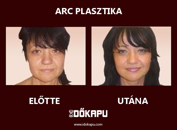 Arc plasztika
title=